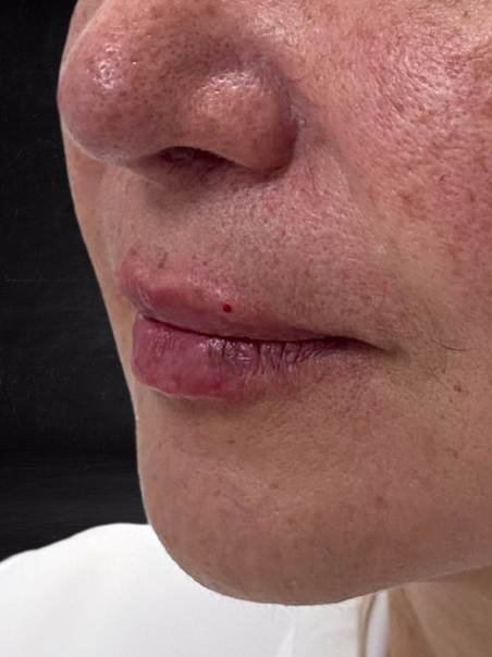 After - Lip Hydration - Case 3