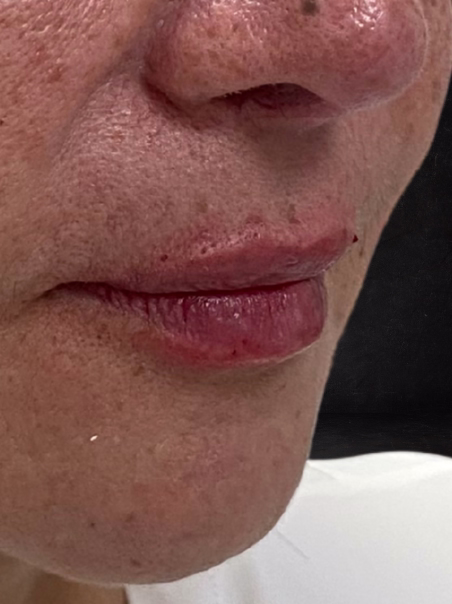 After - Lip Contouring