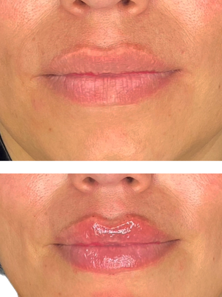 Before - Sensual Lips