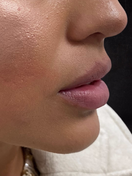 Before - Deep Hydration