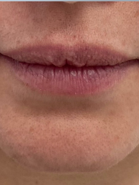 Before - Hydration with Vitamins