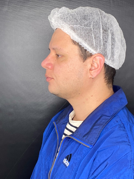 After - Wrinkle Reduction