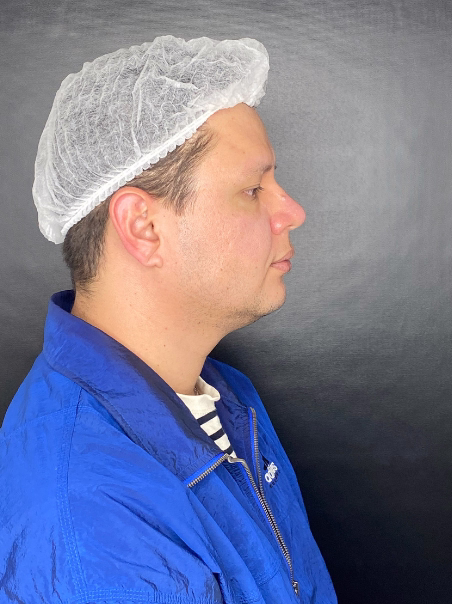 After - Facial Contouring