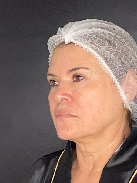 Before Morpheus 8 - Facial firmness