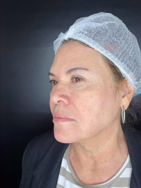 After Morpheus 8 - Facial firmness