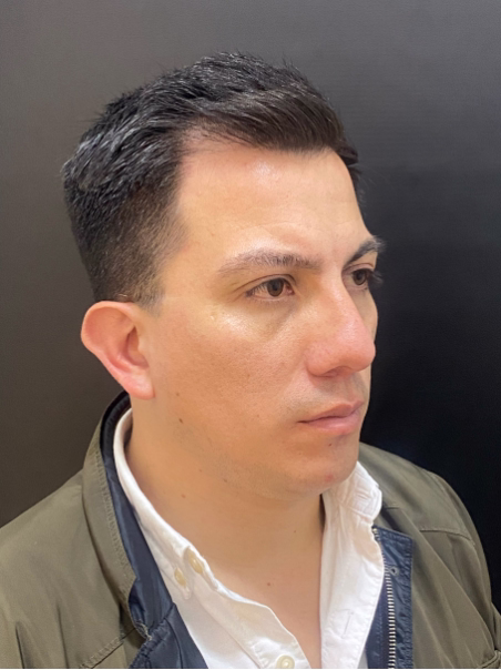 Antes - Ojeras Genéticas