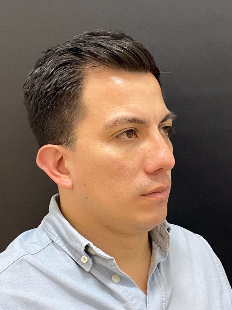 Después - Ojeras Genéticas