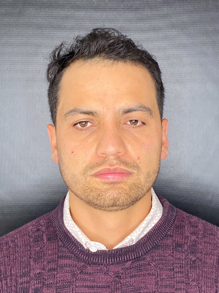 Después - Ojeras con Ácido Hialurónico