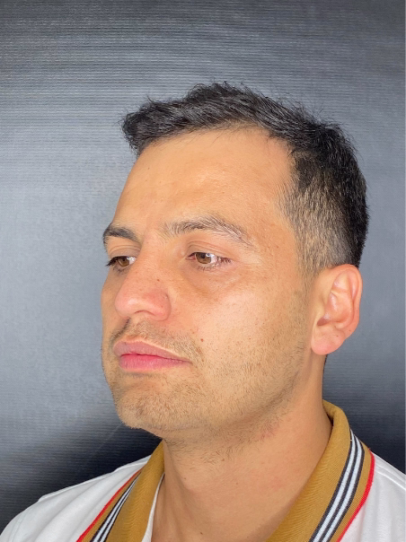 Antes - Ojeras Pigmentadas