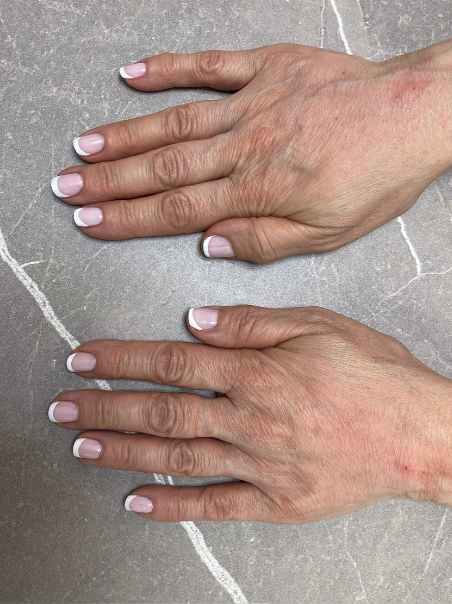 After - Hand Rejuvenation - Full Comparison