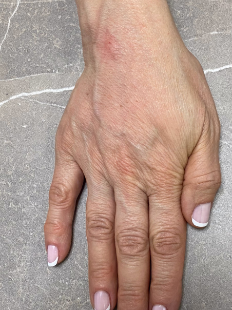 After - Hand Rejuvenation - Back Detail