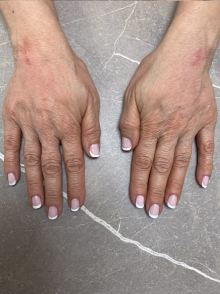 After - Hand Rejuvenation - Front View