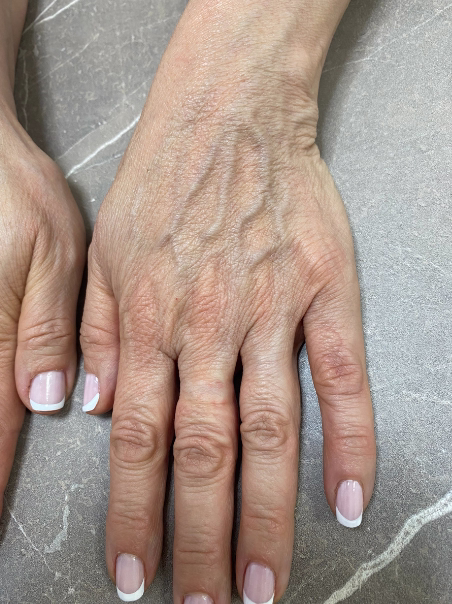 Before - Hand Rejuvenation - Side View