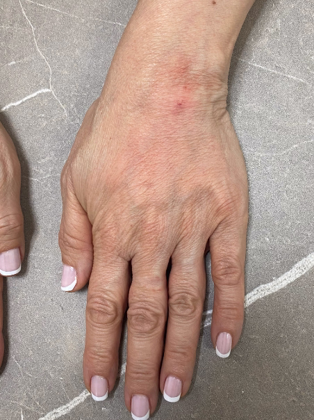 After - Hand Rejuvenation - Side View