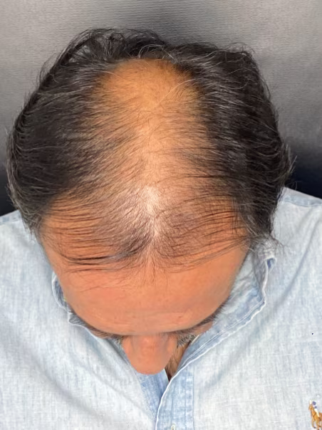 Before Hair Therapy - Alopecia