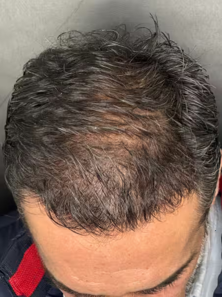 After Hair Therapy - Alopecia