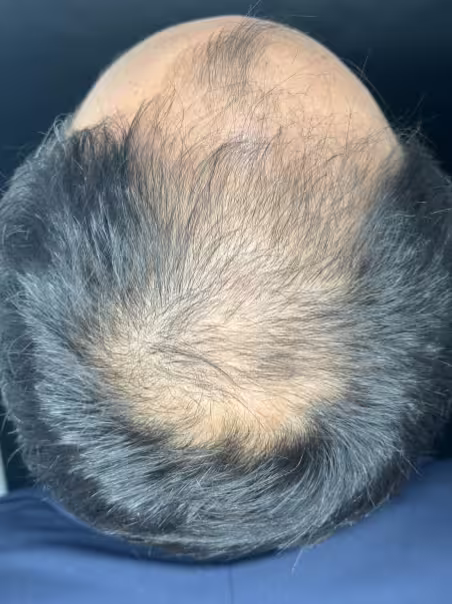 After Intensive Hair Therapy