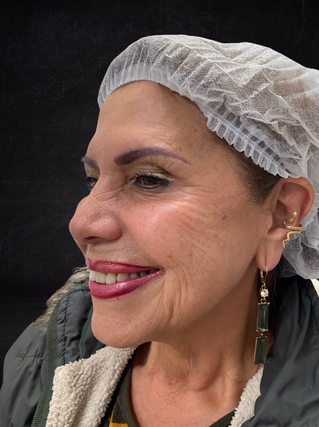 After - Wrinkle Removal