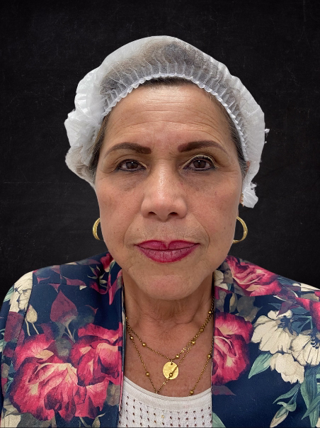 Before - Smoother Forehead