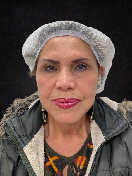 After - Smoother Forehead