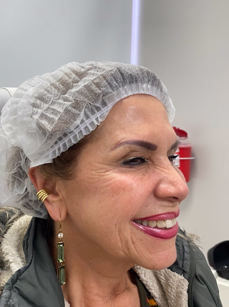 After - Smoother Skin