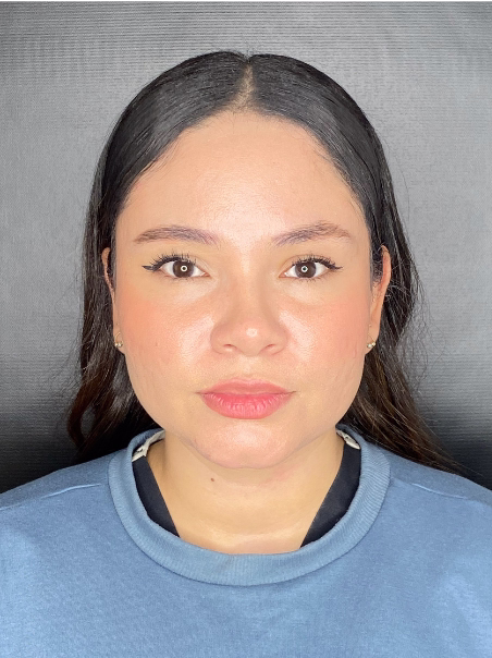 Before - Non-Surgical Brow Lift