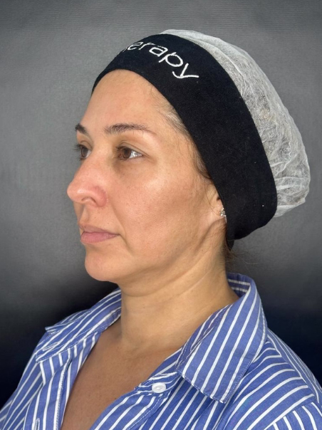 Before - Neck Tightening