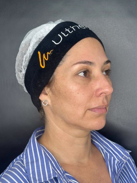 Before - Décolletage Rejuvenation