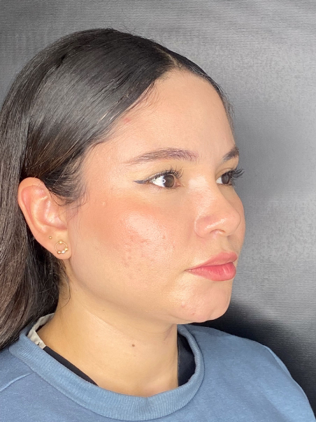 Before - Jawline Definition