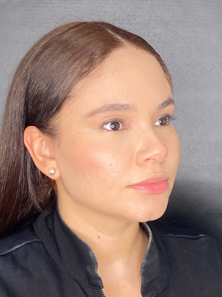 After - Jawline Definition