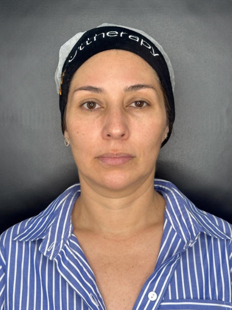 Before - Complete Face Lifting