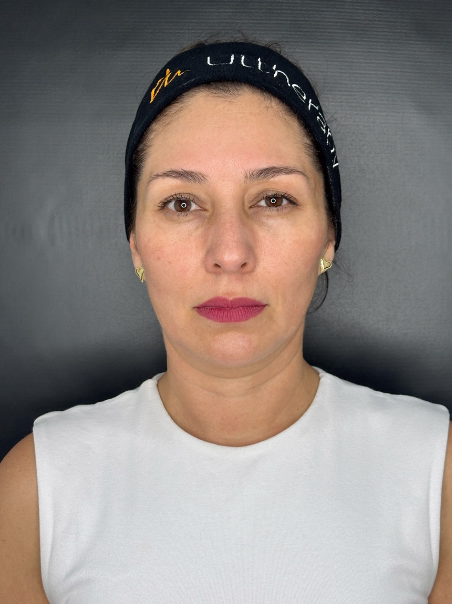 After - Complete Face Lifting